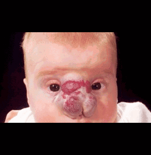 Cô bé có mũi hà mã 'biến' thành mũi cao dọc dừa