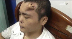 Trung Quốc: Phẫu thuật cấy mũi lên trán