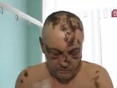 Loại ma túy ghê rợn ăn ruỗng thịt con nghiện