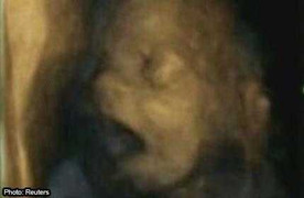 Bé 4 tuổi 'mang thai'