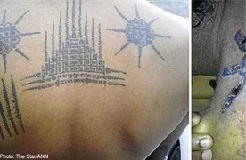 Tử vong sau xóa hình xăm