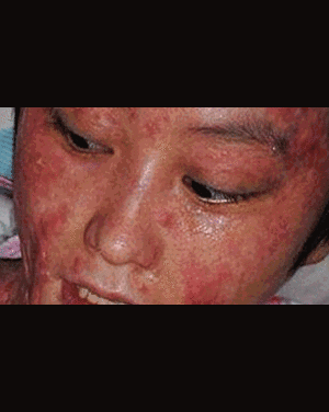 Bạn trai tưới xăng đốt, thiếu nữ xinh đẹp cháy hết mặt