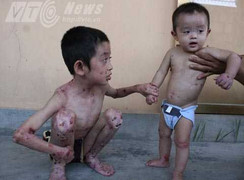 Thương tâm nhà có 2 con mắc bệnh 'giời đày'