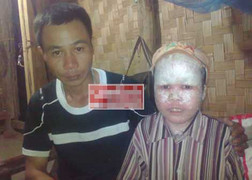 Cậu bé ‘người cá’ suýt bị chôn sống ở Hà Giang