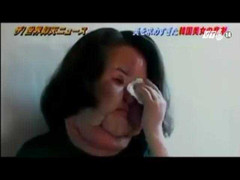 Kinh hoàng mỹ nhân trở nên dị dạng sau phẫu thuật thẩm mỹ