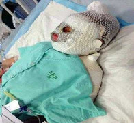 Ôsin lơ là, cô chủ nhỏ bị bỏng nát mặt