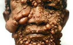 Người đàn ông có hàng trăm khối u kỳ lạ