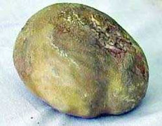 Coi thường chữa trị, viên sỏi trong thận nặng tới 200g