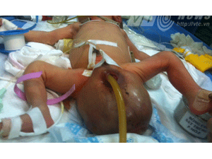 Giật mình bé sơ sinh có khối u to như chiếc đầu
