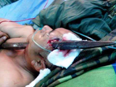 Người bị xà beng đâm xuyên đầu