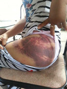 Một phụ nữ tố bị chồng đánh đập dã man