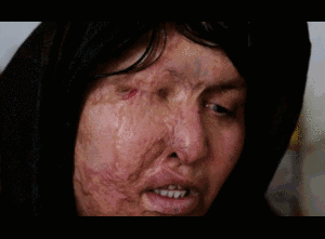 Xót xa người đàn bà bị tạt axit nát mặt