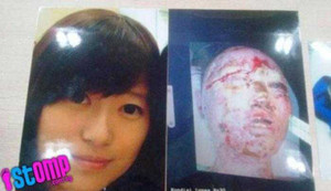 Nữ sinh xinh đẹp bị tình cũ tạt axit nát mặt