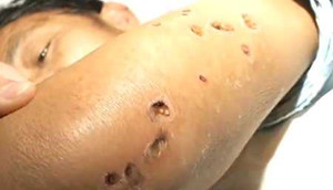 Top 10 côn trùng 'sát thủ' giết người hàng loạt