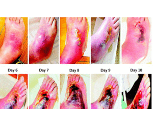 Quý ông thối ruỗng chân vì đi đôi giày mới