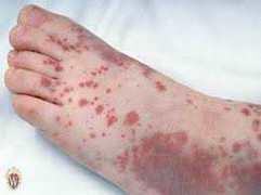 Bùng phát bệnh lạ xuất huyết nội tạng