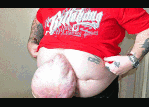 Kỳ lạ người đàn ông có ruột nằm ngoài ổ bụng