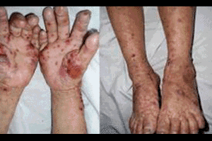 Truy tìm nguyên nhân gây bệnh lạ xuất huyết nội tạng