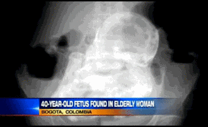 Cụ già 82 có bào thai 40 tuổi