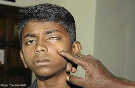 Nam sinh 11 tuổi mù mắt vì chơi rượt bắt