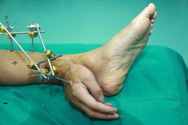 Trung Quốc: Phẫu thuật cấy tay lên chân