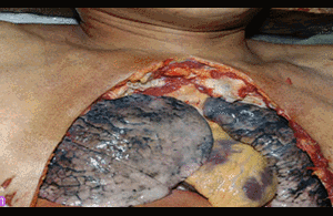 Rùng mình xem thuốc lá phá huỷ nội tạng người