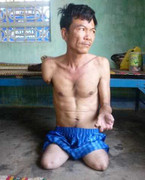 Kinh hoàng cảnh người đàn ông rụng dần chân tay