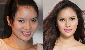 Gái quê Lê Thị Phương và 3 lần thẩm mỹ đau đớn