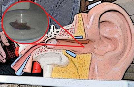 Gián to đùng chui vào tai, quý ông đau đớn