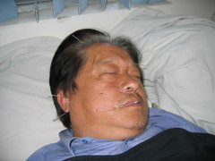 Bệnh lạ gây lệch mặt, méo miệng ở TP.HCM