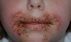 Khăn ướt gây hại cho trẻ sơ sinh