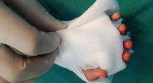 Nối 4 ngón tay đứt rời cho bệnh nhi nhỏ tuổi nhất