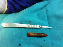 Rút thanh tre 5 cm nằm trong sọ 9 tháng