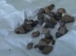 Nữ sinh khóc ra đá, bác sỹ 'bó tay'