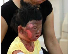 Đổ xăng, 5 người trong một gia đình phỏng nặng