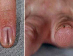 Tá hỏa phát hiện khối u “núp” dưới móng tay