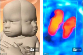 Sốc với em bé dính liền hai khuôn mặt