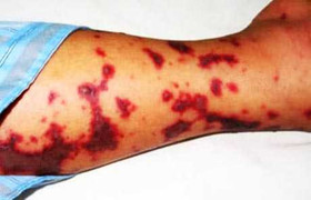 Cứu sống bệnh nhân nhiễm não mô cầu