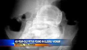 Sửng sốt một phụ nữ mang bào thai 40 năm