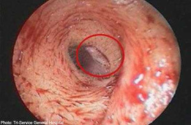 Rùng mình cảnh ấu trùng ruồi “ăn nát” ống tai