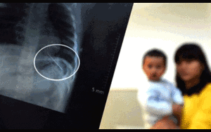 Ai đã đâm kim dài 5cm vào phổi bé trai?