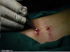 Cảnh lấy 42 viên ngọc trai khỏi cơ thể