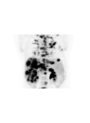 Thuốc mới làm tiêu 70 khối u chết người trong 12 tuần