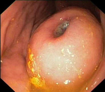 Dạ dày đau, cẩn thận biến chứng ung thư thế này