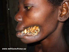 Căn bệnh kỳ quái làm biến dạng khuôn mặt