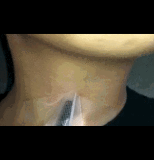 Bút chì đâm xuyên cổ họng học sinh lớp 1