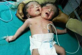Video: Em bé chào đời với 2 đầu, 1 thân