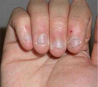 Cắn móng tay cũng gây chết người