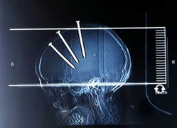 3 đinh dài 10cm ghim vào sọ