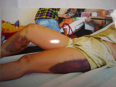 Một phụ nữ bị chích thanh sắt nung nóng vào mặt